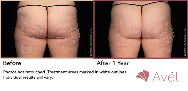 Aveli Before and After Treatment Buttocks