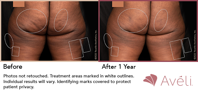 Aveli before and after treatment buttocks 4