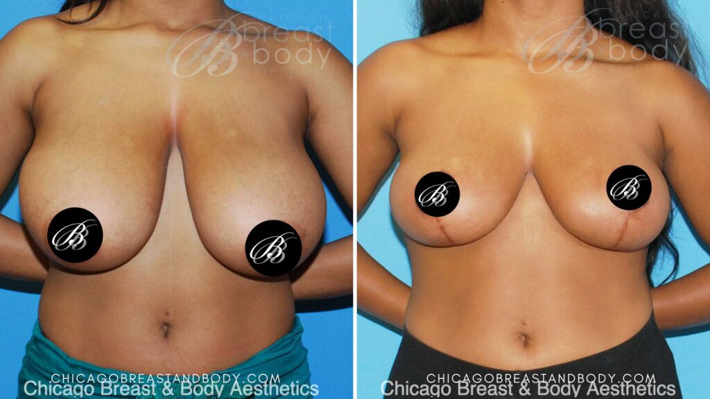 breast reduction mammaplasty chicago breast and body