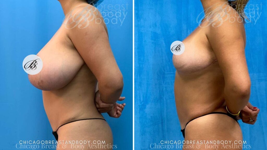 breast reduction mammaplasty chicago breast and body