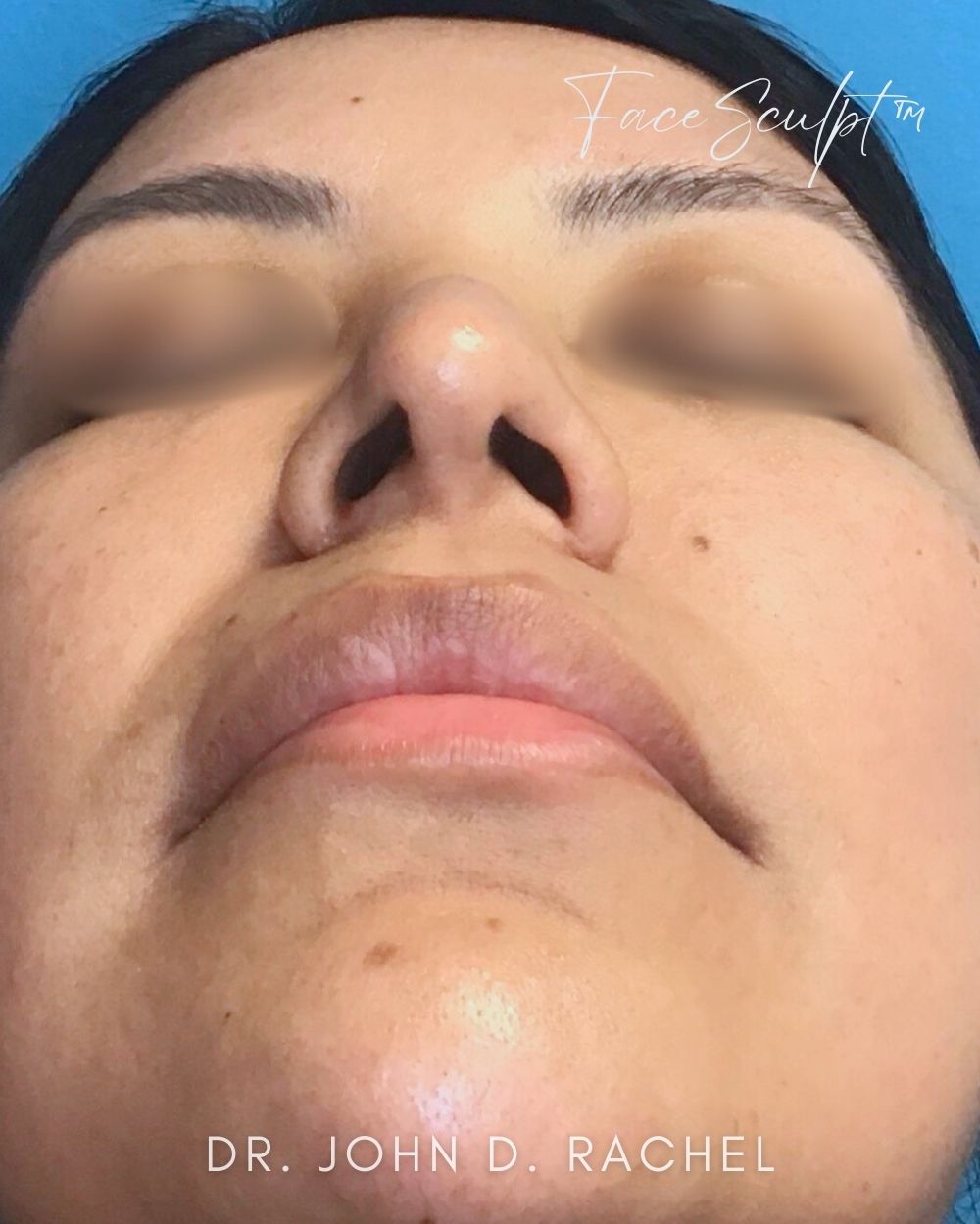 Rhinoplasty after photo 2, case #1111241, Dr. John Rachel, Chicago Breast & Body