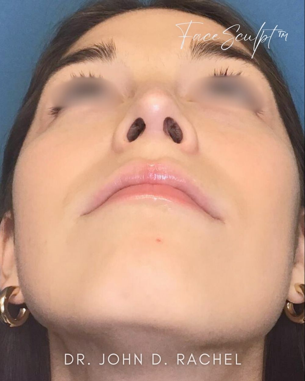 Rhinoplasty after photo 2, case #122244, Dr. John Rachel, Chicago Breast & Body
