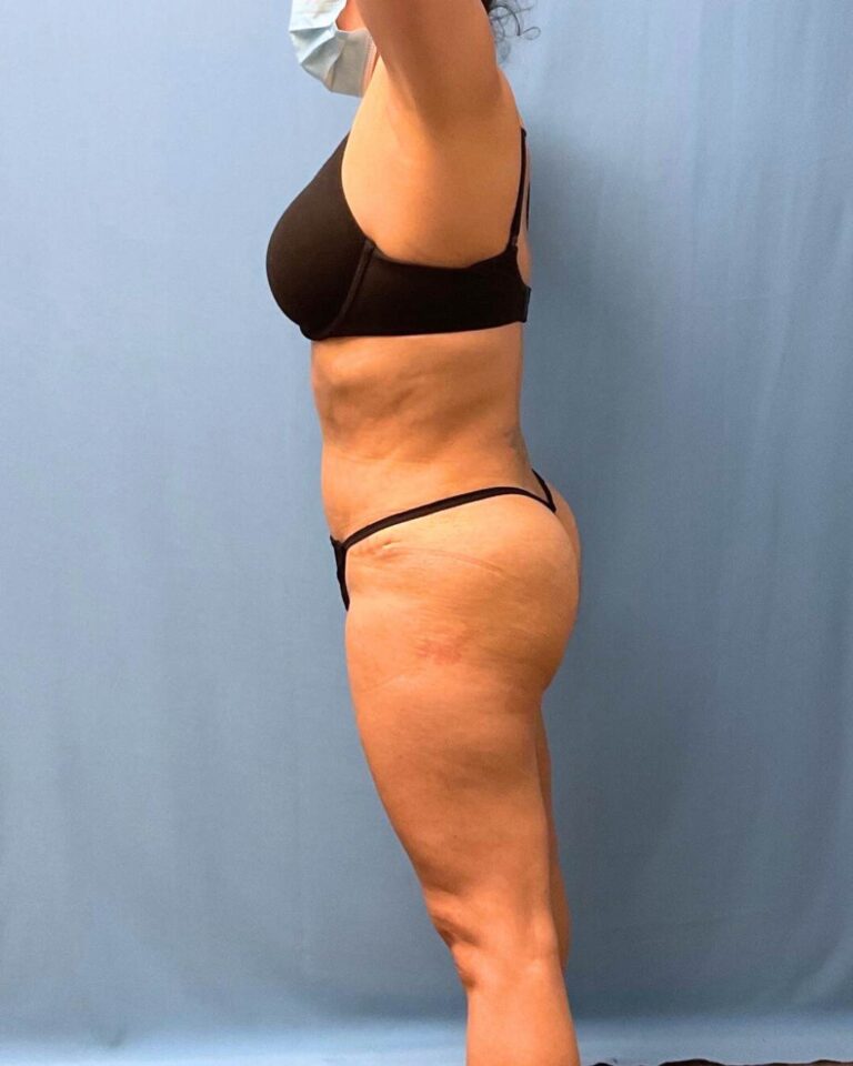 After Lipo 360, side view, 3 months after surgery, case 1821713, patient of Dr. Kevin Lin