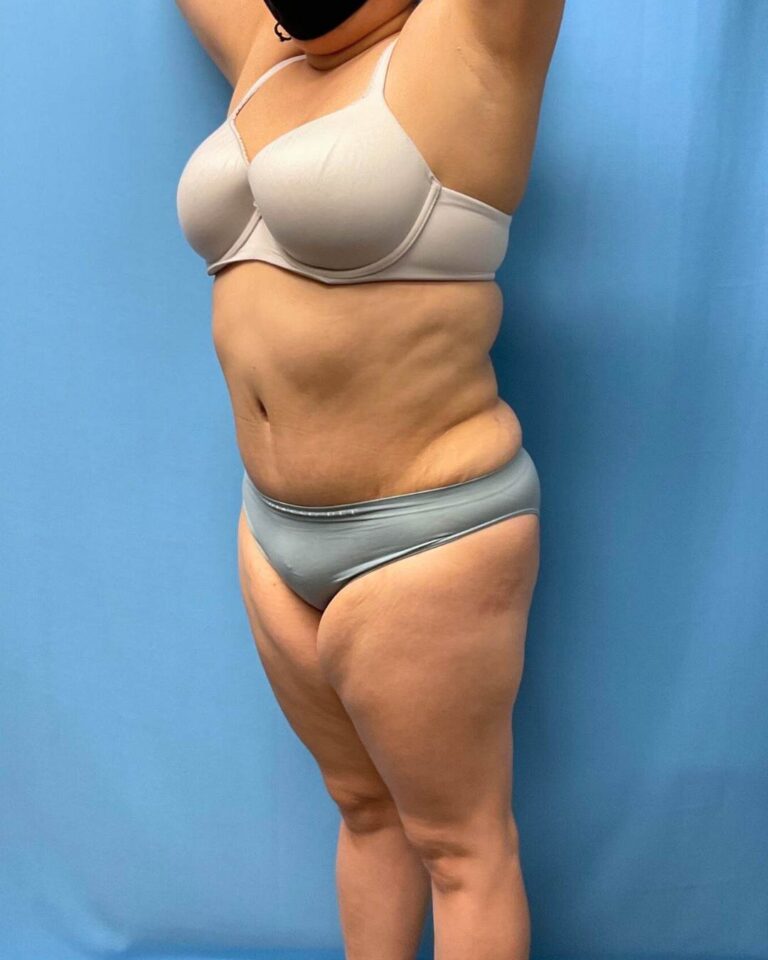 Before Lipo 360, front angle, case 1821713, patient of Dr. Kevin Lin