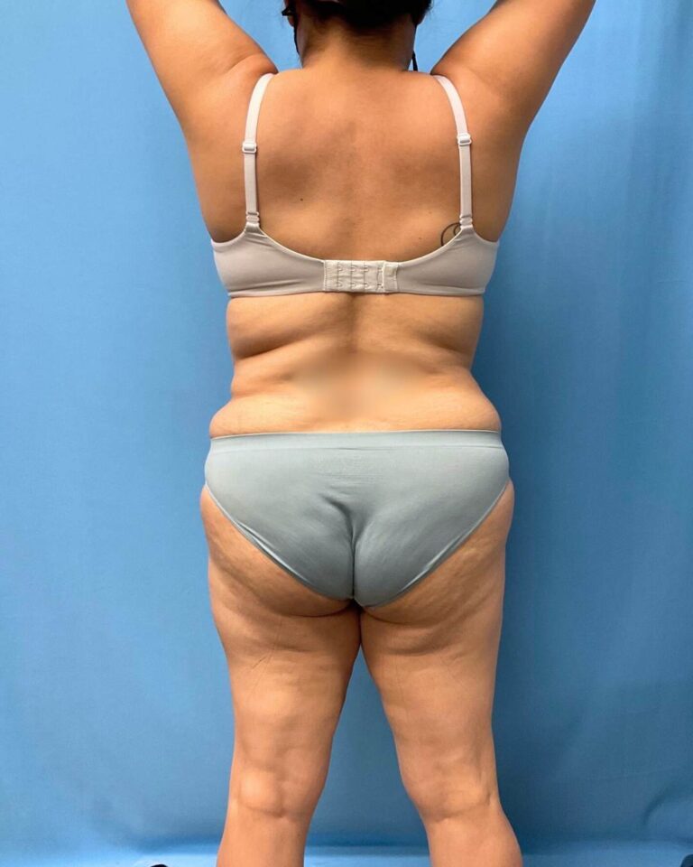 Before Lipo 360, back view, case 1821713, patient of Dr. Kevin Lin
