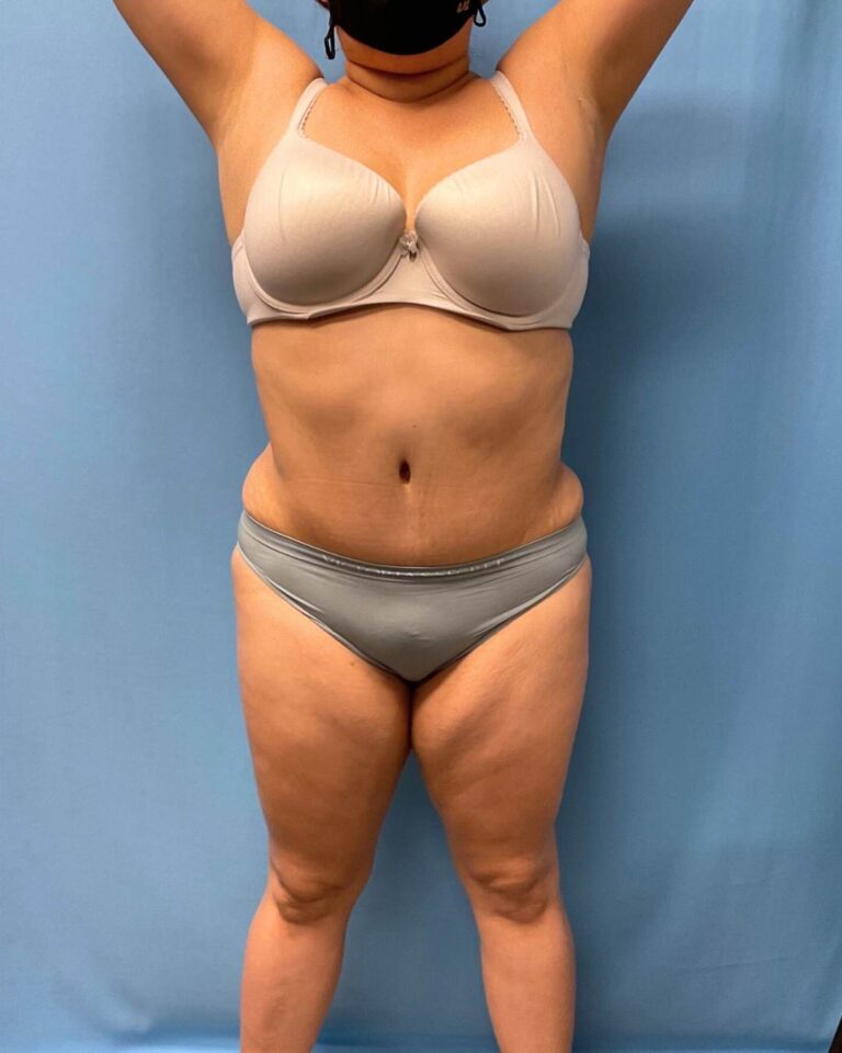 Before Lipo 360, front view, case 1821713, patient of Dr. Kevin Lin