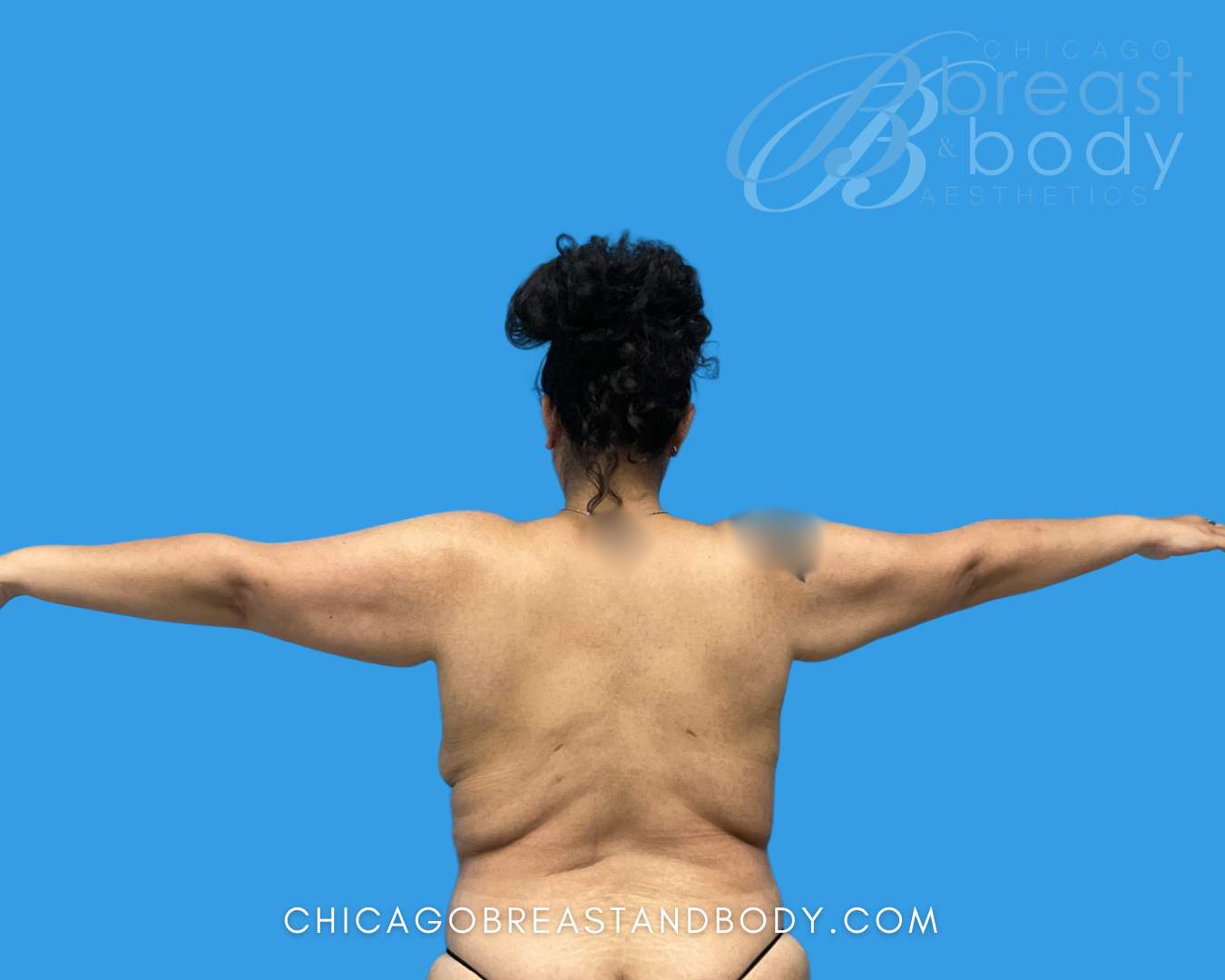 2115211 Brachioplasty Arm Lift Before And After Photos 4Mo By Dr. Kevin Lin Chicago 3 | Chicago Breast And Body Aesthetics
