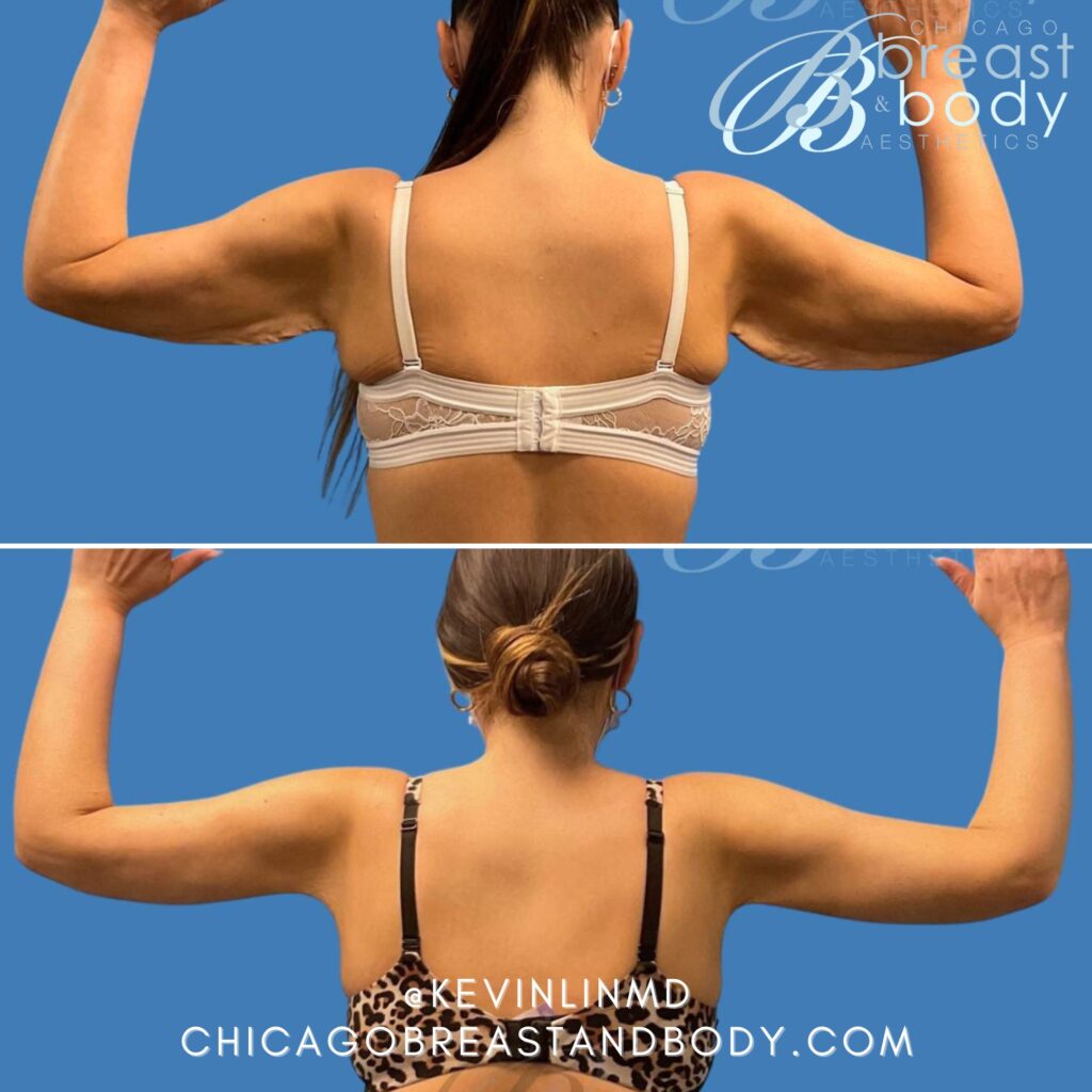 1893195 1Mo Brachioplasty Arm Lift By Dr. Kevin Lin Chicago (2)