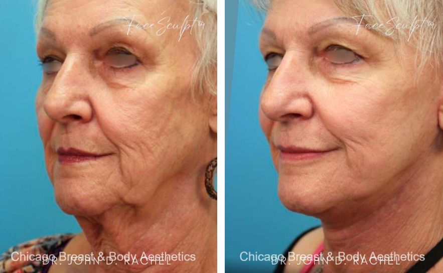 Before and After Facelift