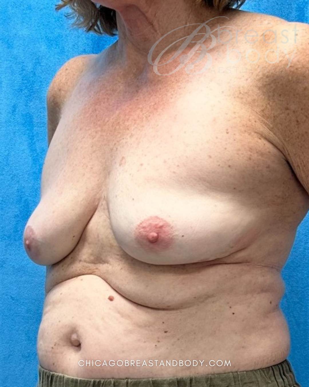 Breast Implant Removal after photo 5, case #2303599, Dr. Anh-Tuan Truong, Chicago Breast & Body