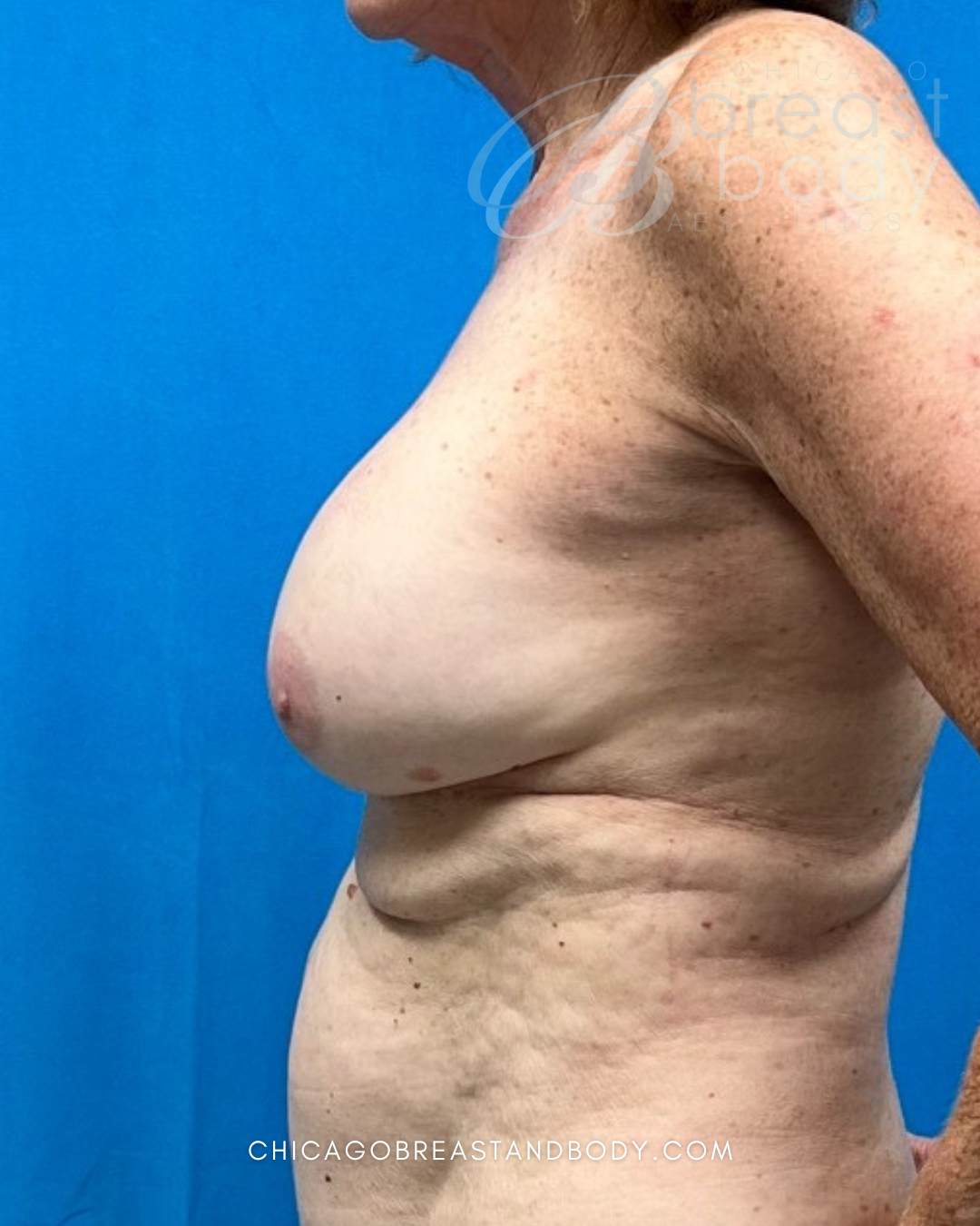Breast Implant Removal before photo 4, case #2303599, Dr. Anh-Tuan Truong, Chicago Breast & Body