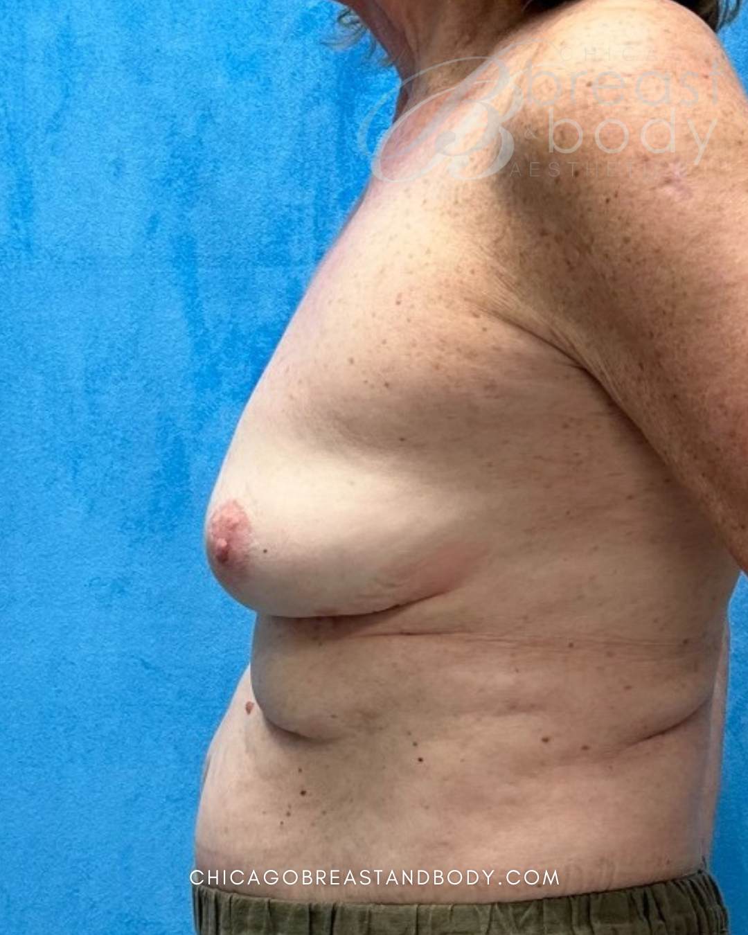 Breast Implant Removal after photo 4, case #2303599, Dr. Anh-Tuan Truong, Chicago Breast & Body