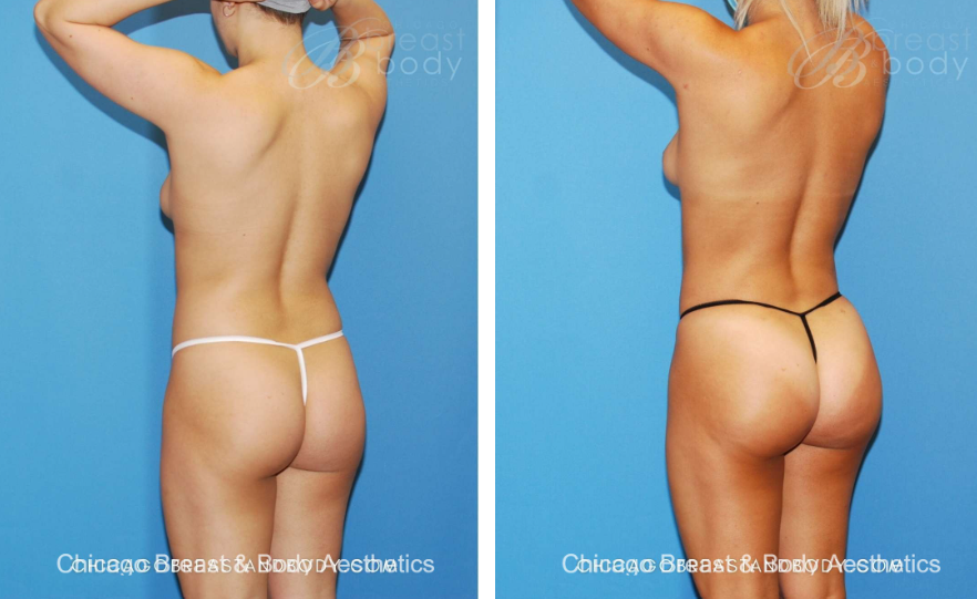 Skinny BBL Before After by Dr. Anh Tuan Truong