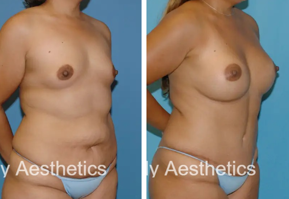 Mommy Makeover B and A