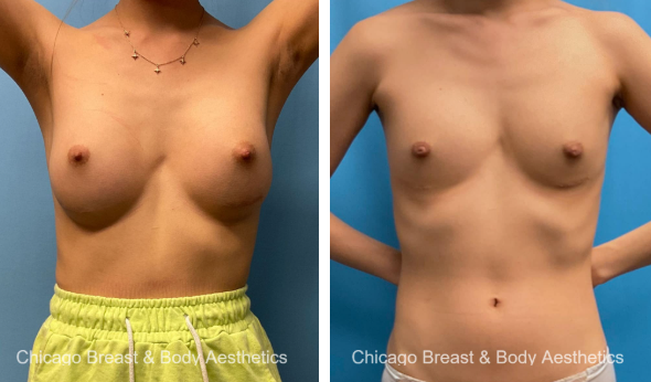 Implant removal b and a