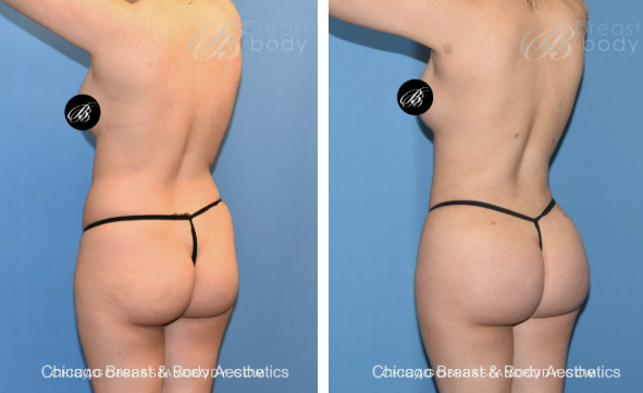 Brazilian Butt Lift before and after photo chicago breast and body