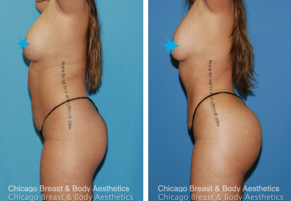 Lipo 360 and Brazilian Butt Lift Before and after chicago breast and body