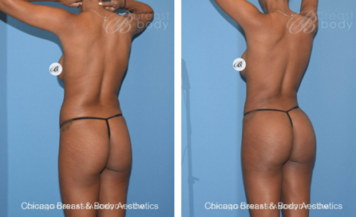 Country Club BBL lipo 360 before and after photo side by side chicago breast and body