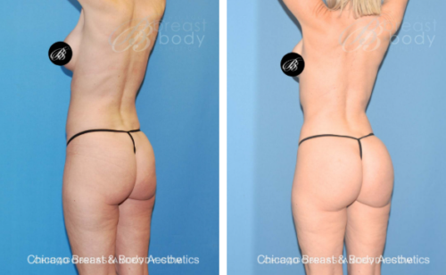 Country Club BBL lipo 360 before and after photo side by side chicago breast and body