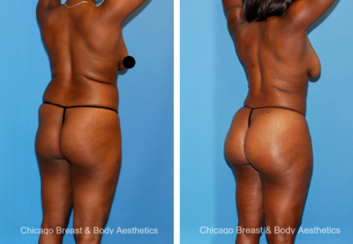 lipo 360 before and after photo side by side chicago breast and body