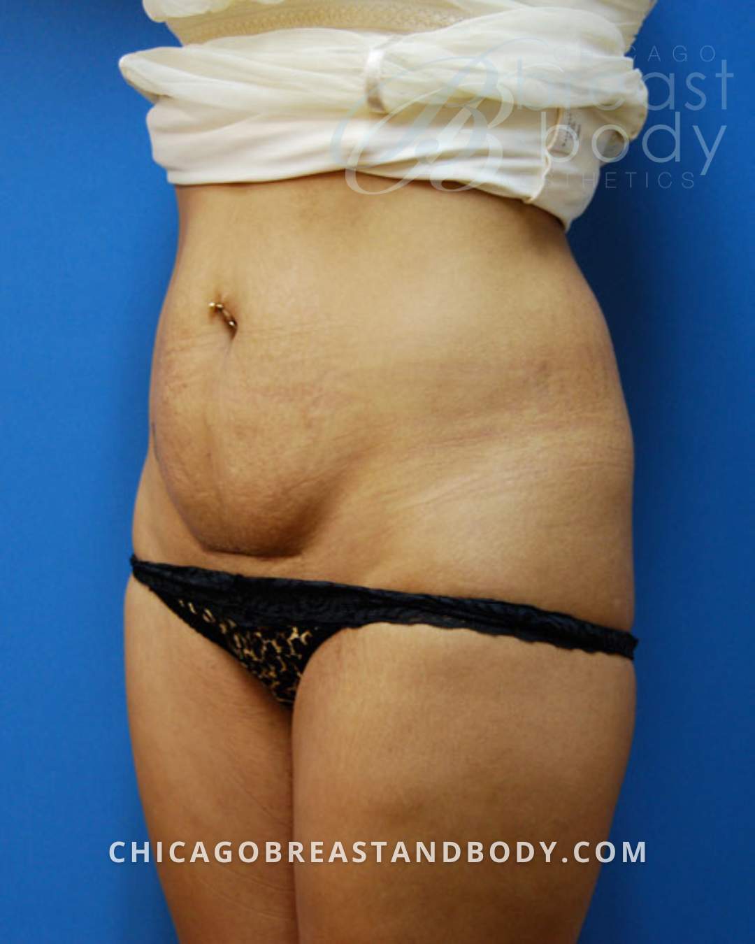 Mini -Tummy Tuck before photo 3, case #122, Dr. Anh-Tuan Truong, Chicago Breast & Body