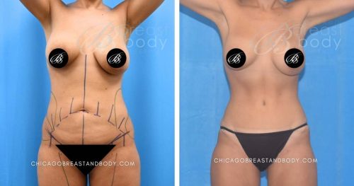 Before After photo of mini tummy tuck by Dr. Anh Tuan Truong Chicago Breast and Body 1851169