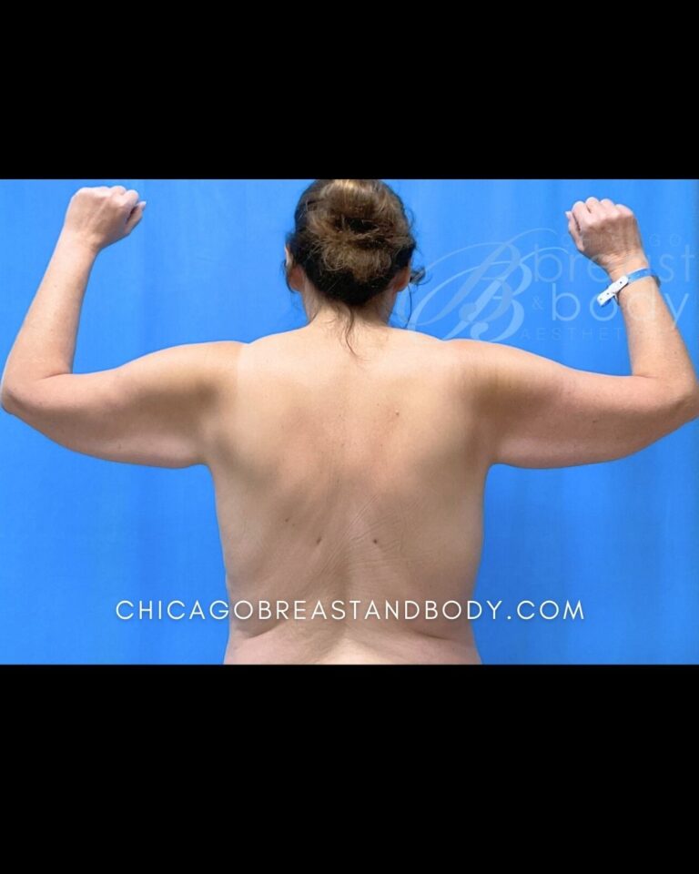 Before Brachioplasty arm lift photo, case 2182140, patient of Dr. Kevin Lin, back view, arms raised
