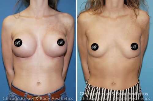 breast implant removal before after by dr truong chicago breast and body