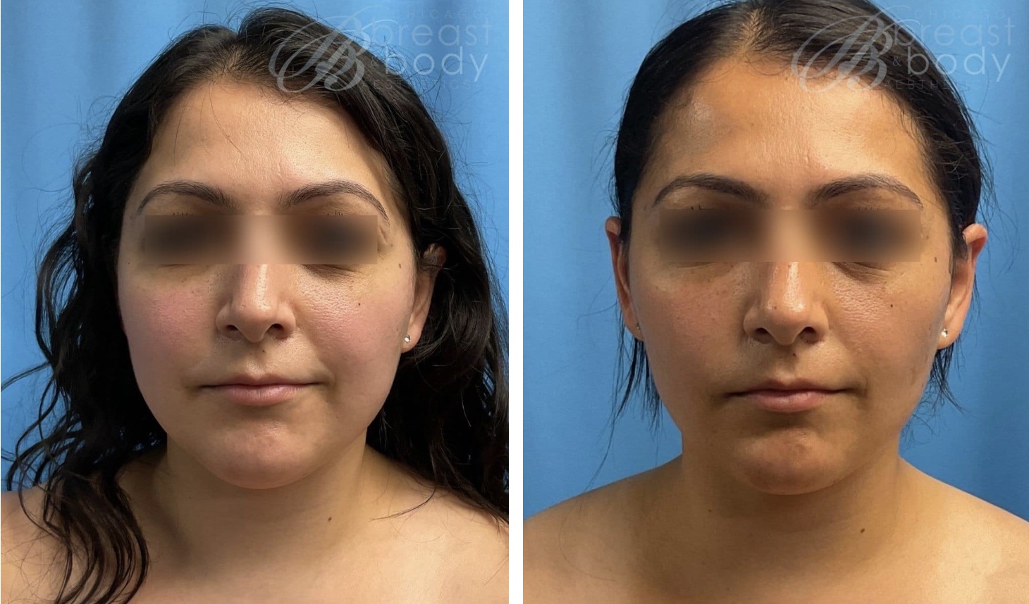 buccal fat removal 1575027