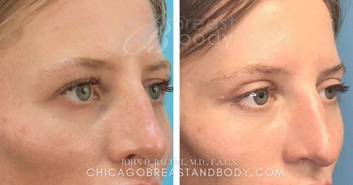 1001245 Upper Eyelid Blepharoplasty By Dr. John Rachel Chicago Breast And Body