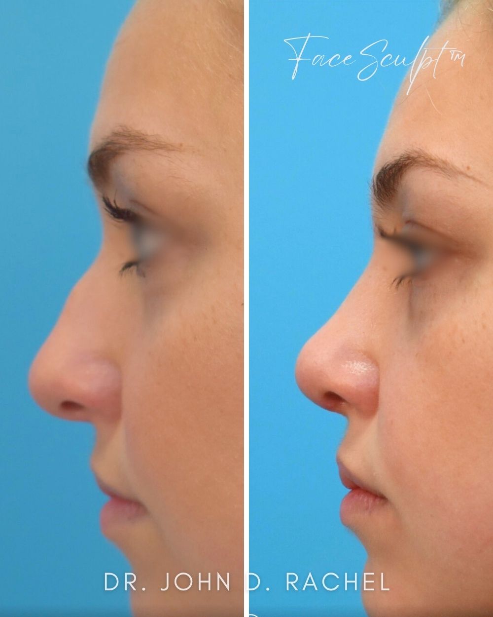 Rhinoplasty before photo 4, case #1029243, Dr. John Rachel, Chicago Breast & Body