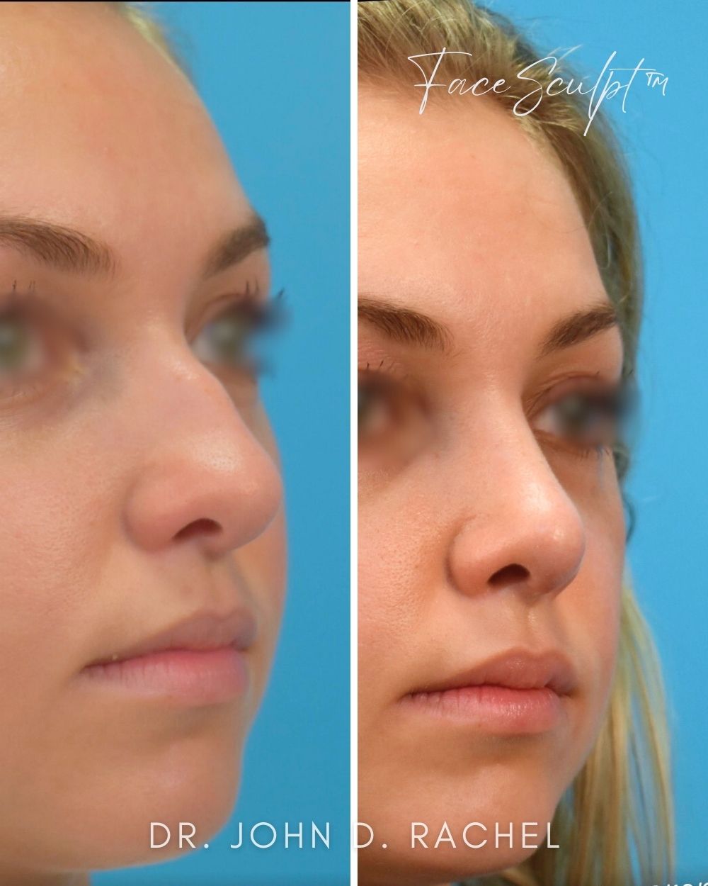 Rhinoplasty after photo 4, case #1029243, Dr. John Rachel, Chicago Breast & Body