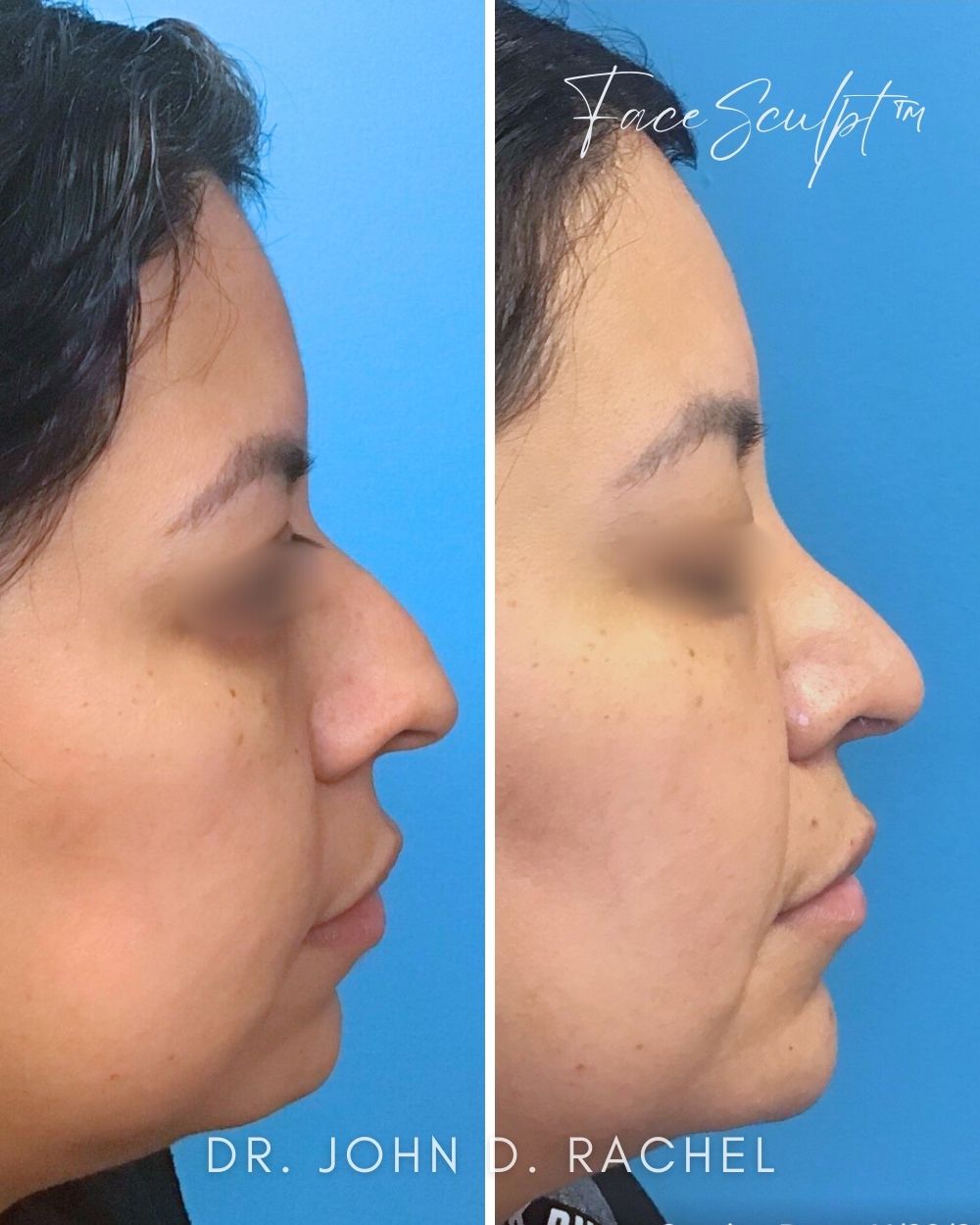 Rhinoplasty after photo 3, case #1111241, Dr. John Rachel, Chicago Breast & Body