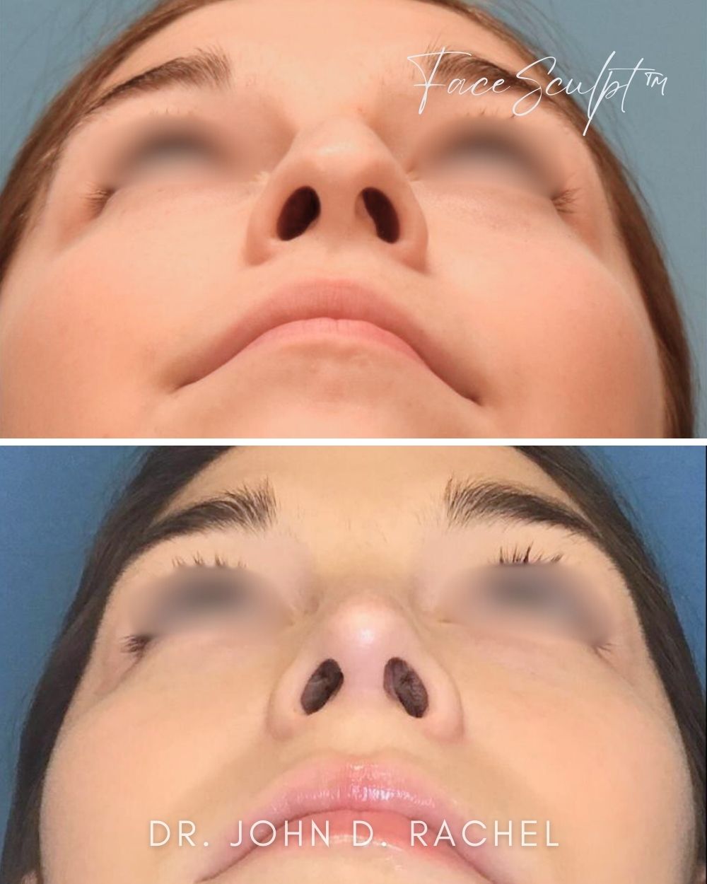 Rhinoplasty after photo 3, case #122244, Dr. John Rachel, Chicago Breast & Body