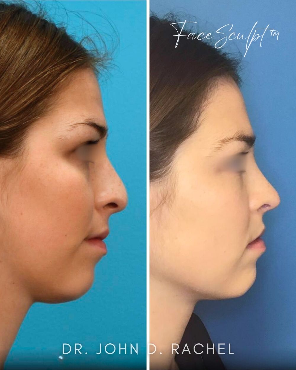 Rhinoplasty before photo 3, case #122244, Dr. John Rachel, Chicago Breast & Body