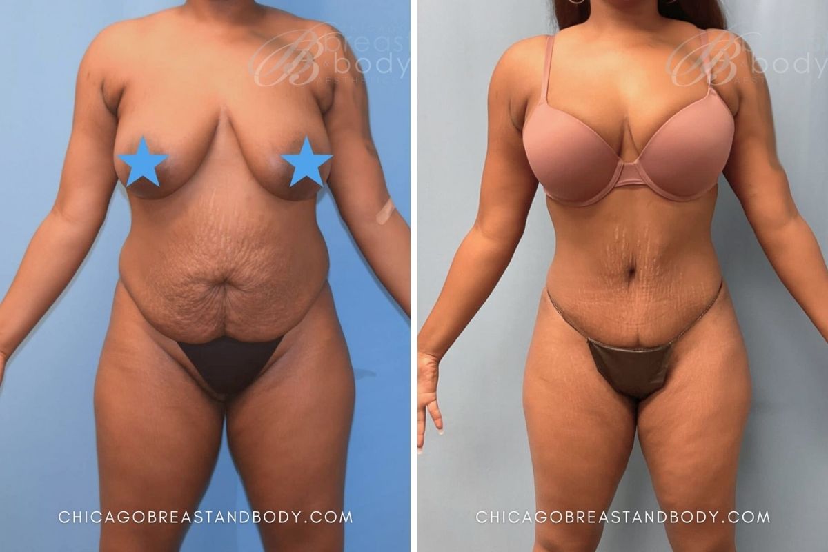 1224 Mommy Makeover Dr. Kevin Lin Chicago 3Mos