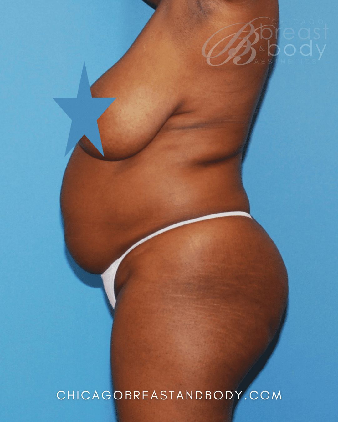 Abdominoplasty (Tummy Tuck), Lipoabdominoplasty (Tummy Tuck with Liposuction), Liposuction before photo 3, case #1628284, Dr. Anh-Tuan Truong, Chicago Breast & Body