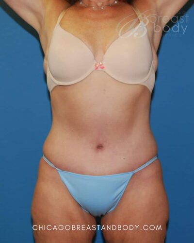 Tummy tuck after photo, case 1635935, actual patient of Dr. Anh-Tuan Truong in Chicago