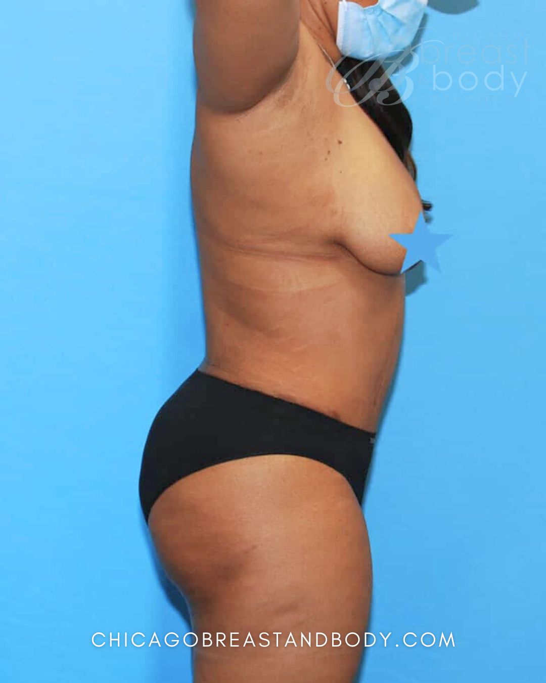 Abdominoplasty (Tummy Tuck) after photo 3, case #1698, Dr. Anh-Tuan Truong, Chicago Breast & Body