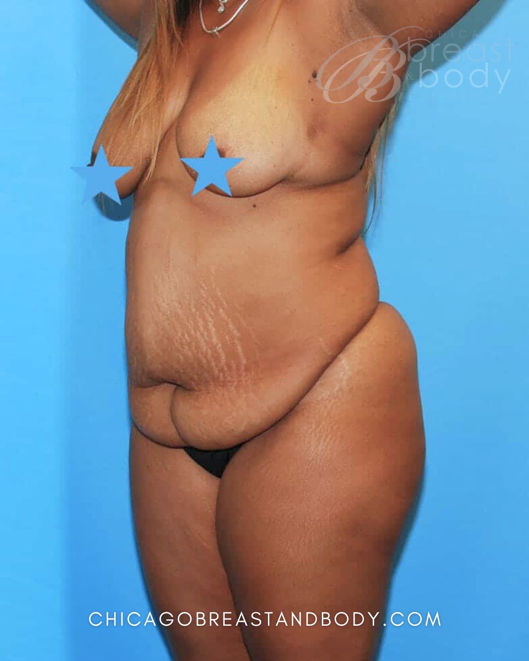 Abdominoplasty (Tummy Tuck) before photo 4, case #1698, Dr. Anh-Tuan Truong, Chicago Breast & Body