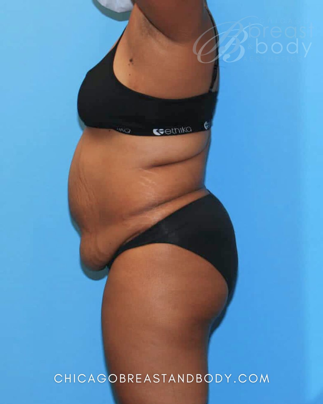 Abdominoplasty (Tummy Tuck) before photo 5, case #1698, Dr. Anh-Tuan Truong, Chicago Breast & Body