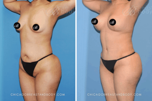 1728742 Mommy Makeover Dr. Anh-Tuan Truong Chicago 6Mos