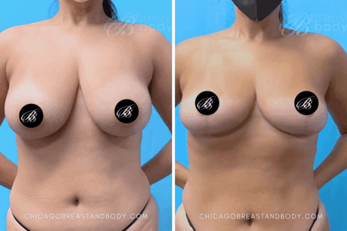 1777008 Breast Reduction Dr. Kevin Lin Chicago 5mos