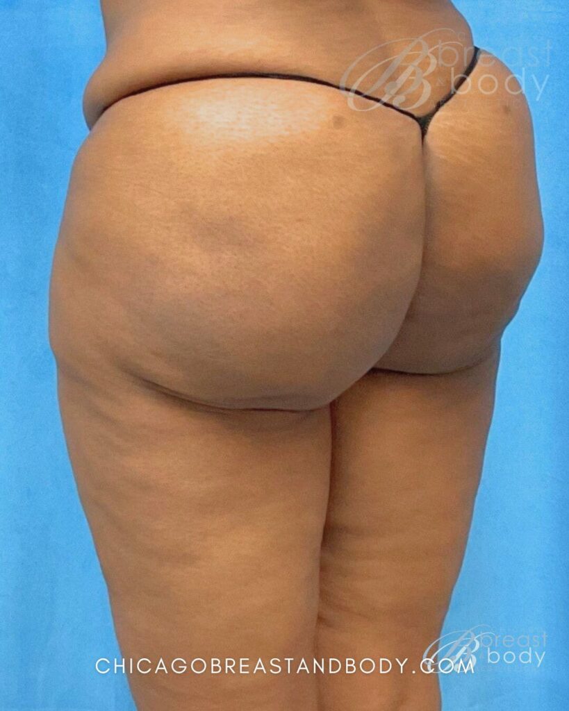 1820605 Cellulite Reduction Dr. Kevin Lin Chicago 1mo