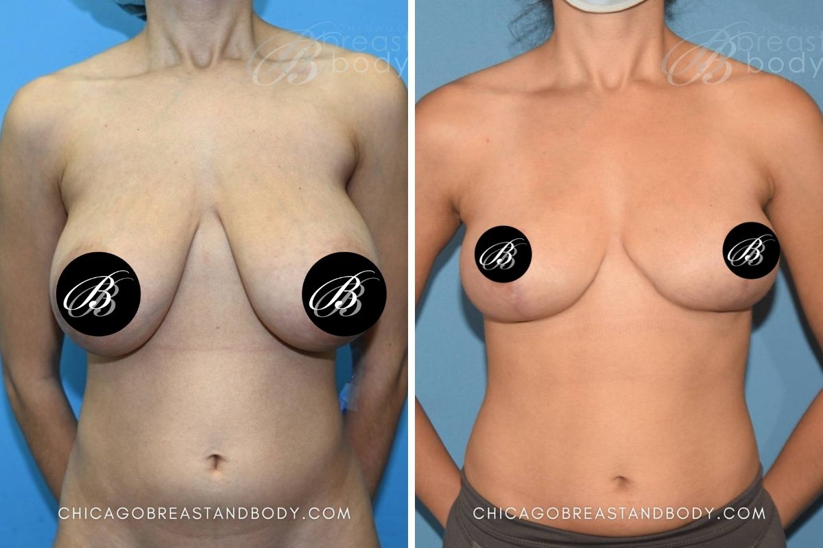 1828542 Breast Reduction Dr. Anh-Tuan Truong Chicago 6mos