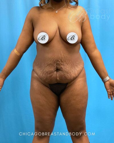 Tummy tuck before photo, case 1850366, actual patient of Dr. Kevin Lin in Chicago