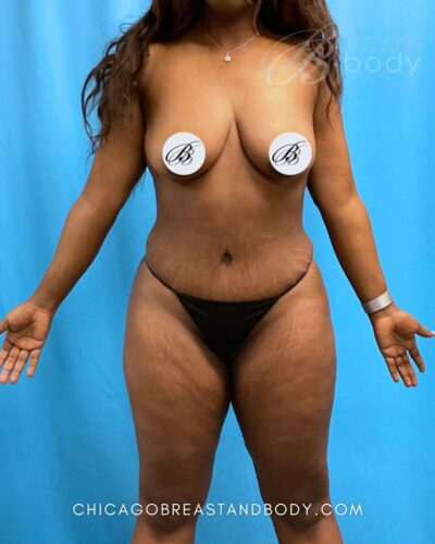 Tummy tuck after photo, case 1850366, actual patient of Dr. Kevin Lin in Chicago