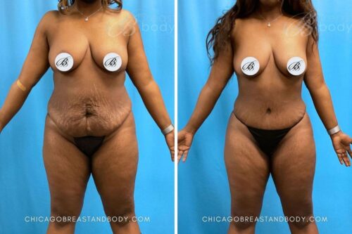 1850366 Tummy Tuck Dr. Kevin Lin Chicago 7mos