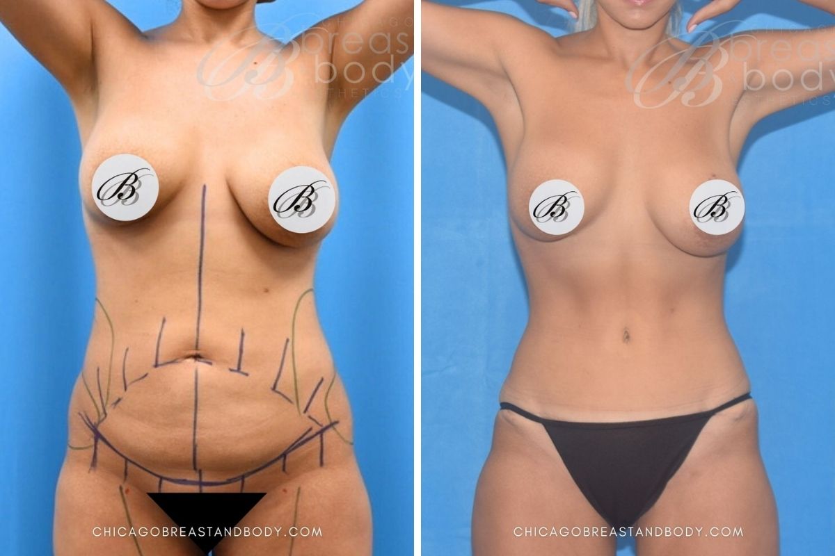 1851169 Tummy Tuck Dr. Anh-Tuan Truong Chicago 17Mos