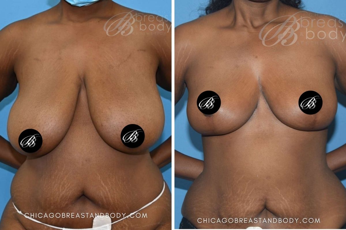 1880787 Breast Reduction Dr. Anh-Tuan Truong Chicago 3mos